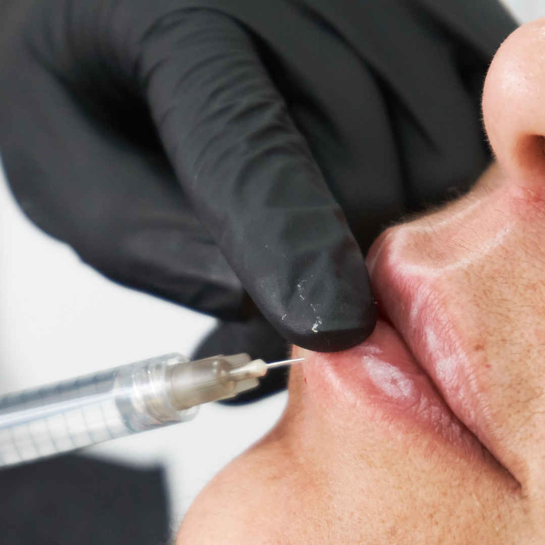 tratamiento toxina botulínica